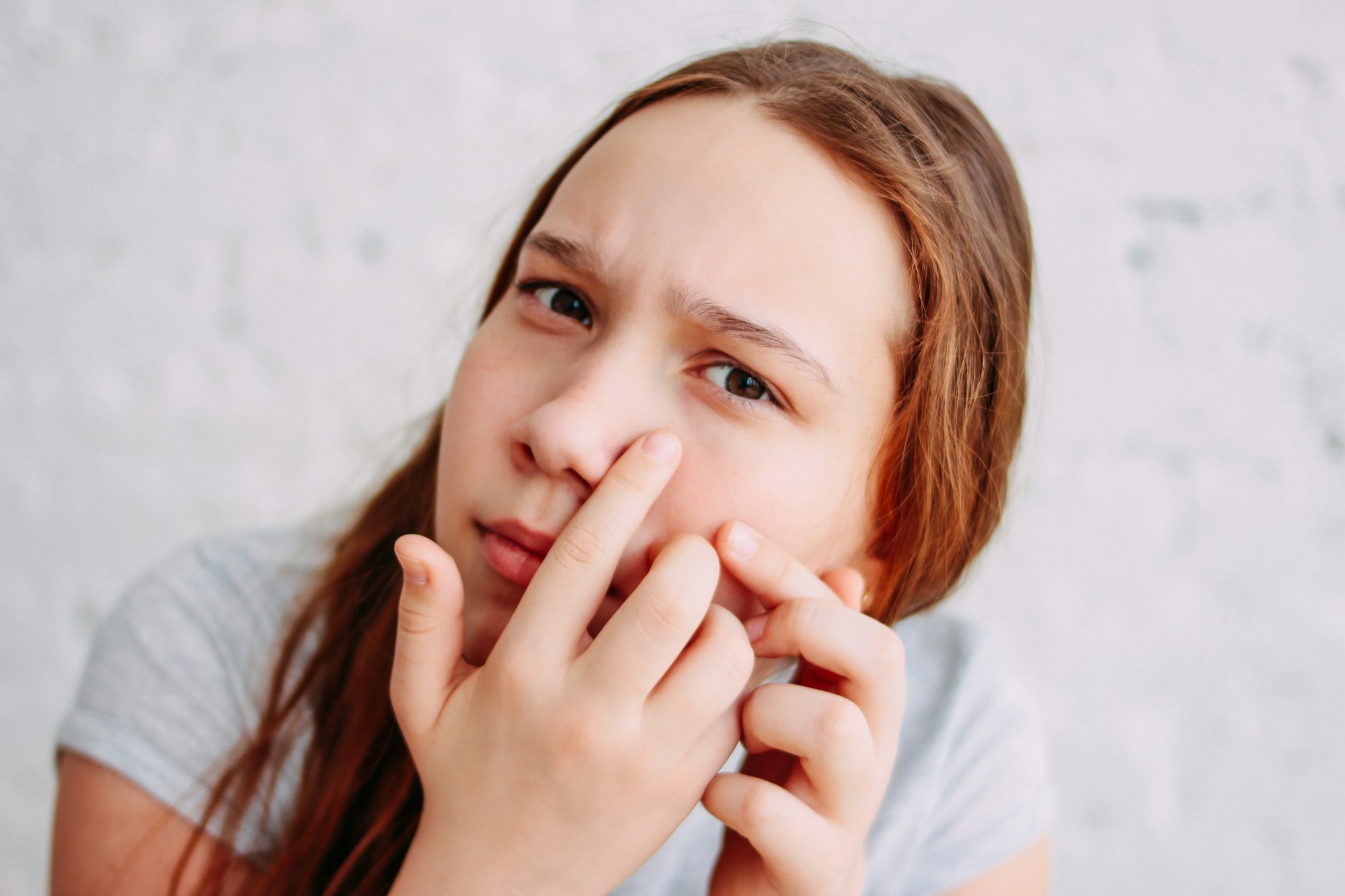 טיפול באקנה ברעננה